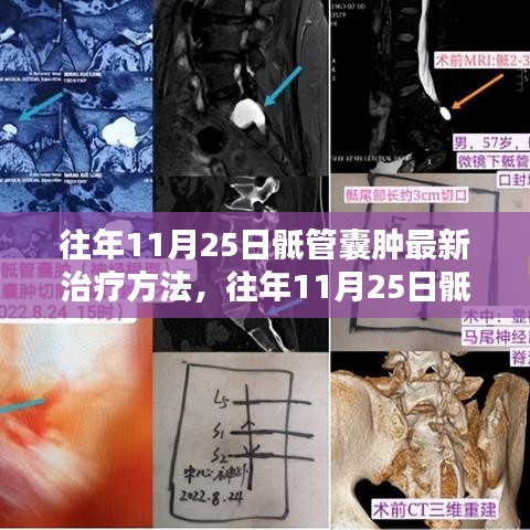 往年11月25日骶管囊腫最新治療方法研究及探索
